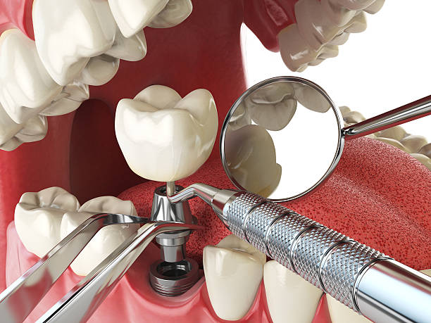 Best Emergency Tooth Extraction in West Deland, FL